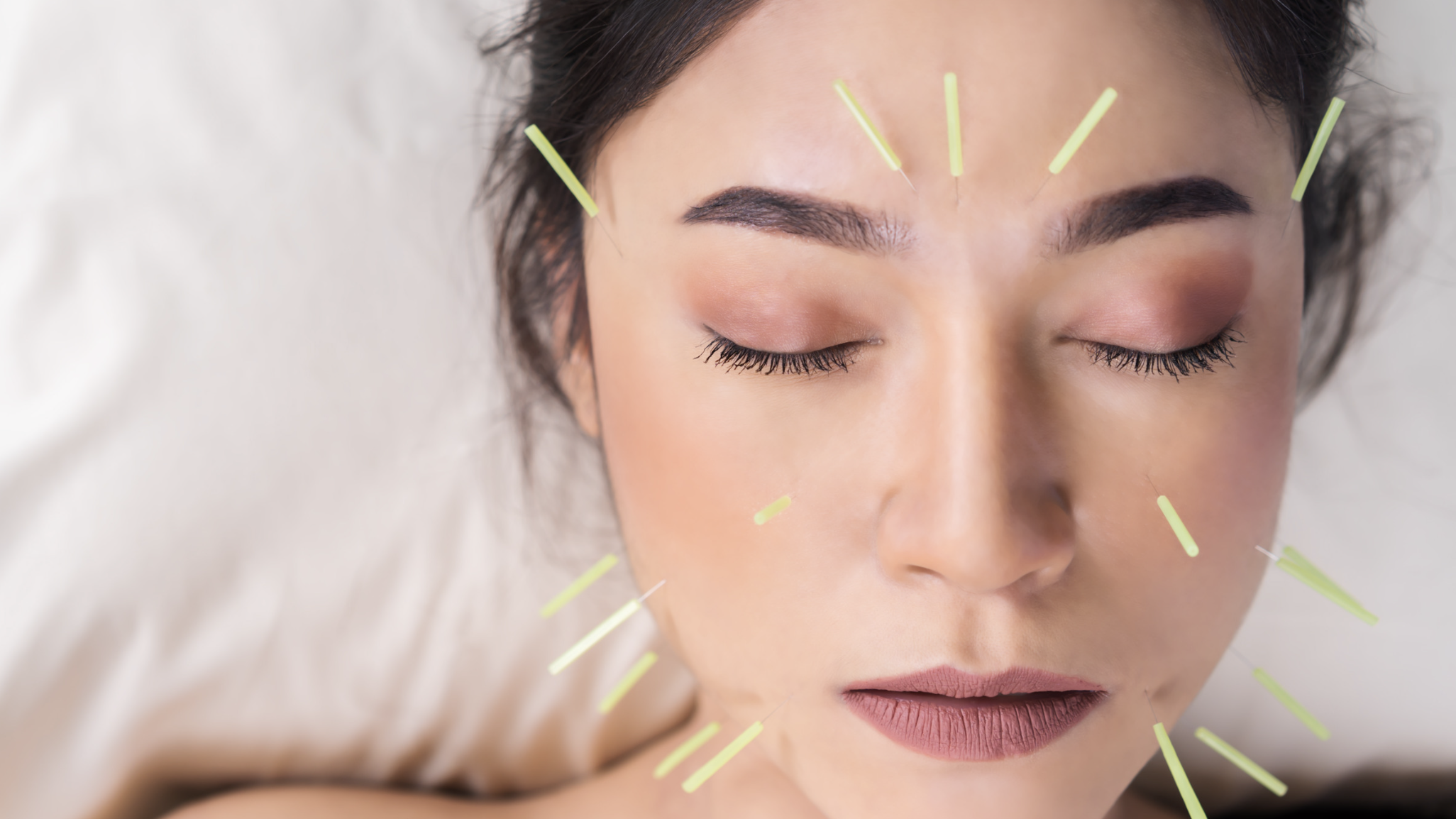 Asian woman getting culturally safe acupuncture